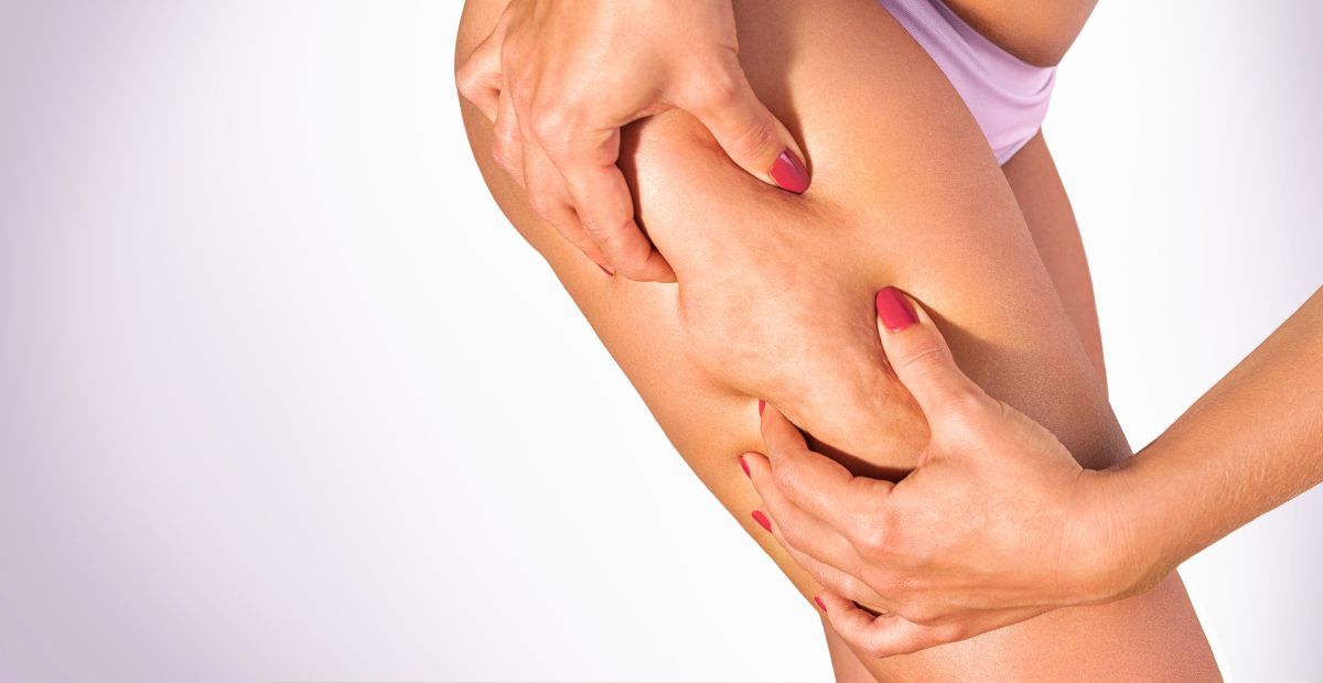 In caso di cellulite ostinata, servono risposte vere e soluzioni concrete. Da noi trovi un team di esperte per raggiungere risultati veri