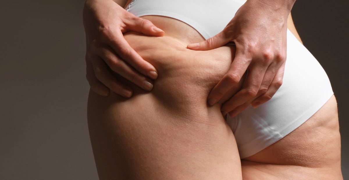 In caso di cellulite ostinata, servono risposte vere e soluzioni concrete. Da noi trovi un team di esperte per raggiungere risultati veri